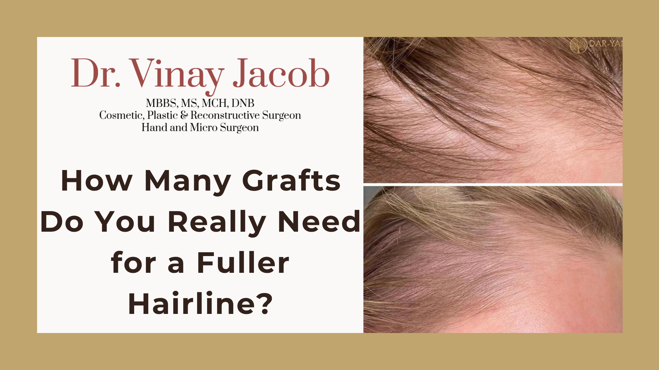 How Many Grafts Do You Really Need for a Fuller Hairline?
